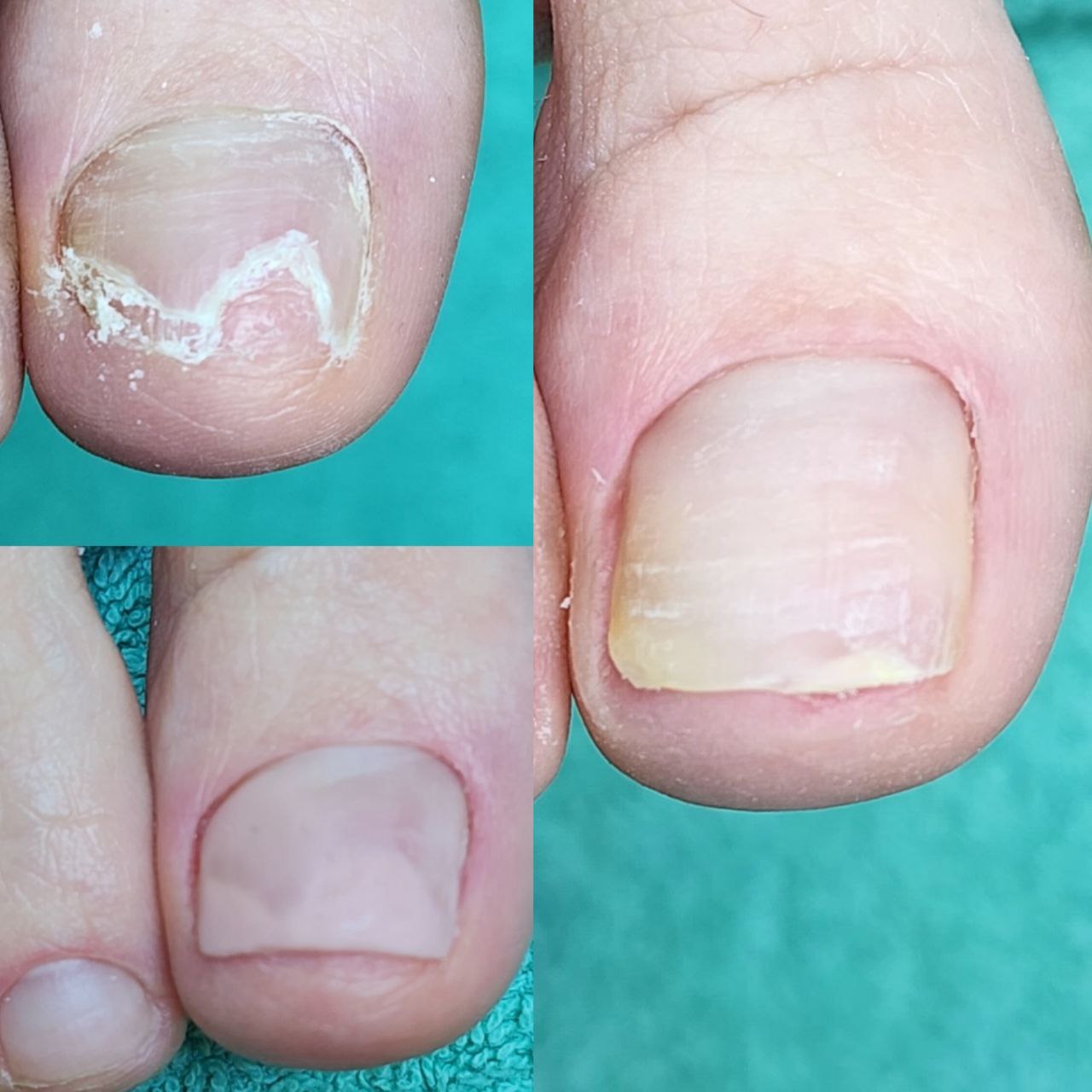 Voor en na een nagelbehandeling bij ZARA Gespecialiseerde Voetzorg